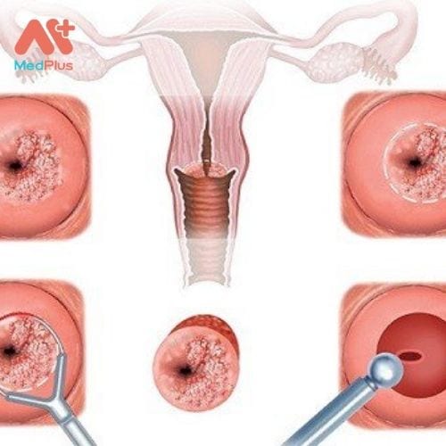 Viêm cổ tử cung là tình trạng viêm nhiễm ở cổ tử cung , lỗ mở hình bánh rán kết nối âm đạo với tử cung. 