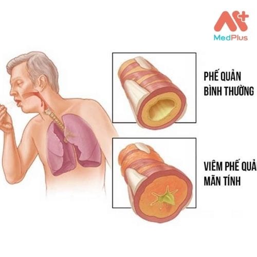 Bệnh viêm phế quản là tình trạng kích ứng và viêm đường dẫn khí đưa không khí vào và ra khỏi phổi của bạn.