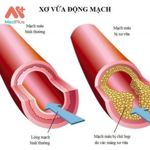 Xơ vữa động mạch có thể ảnh hưởng đến các bộ phận khác của cơ thể