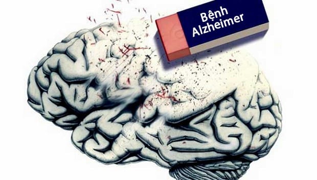 bệnh alzheimer là gì