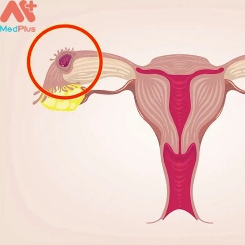 Chảy máu cũng có thể là dấu hiệu của mang thai ngoài tử cung (Hình ảnh minh họa)