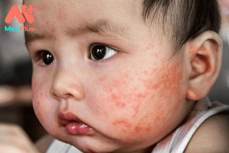 Điều trị bệnh chàm da khó kiểm soát ở trẻ em