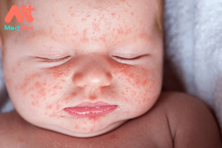 Sử dụng băng ướt cho bệnh chàm da ở trẻ em