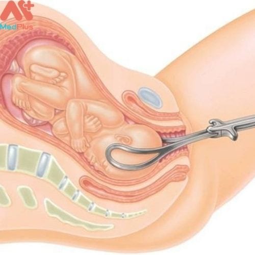 Sử dụng công cụ hỗ trợ khi sinh có thể là nguyên nhân gây ra hiện tượng tụ máu dưới da đầu ở bé (Hình ảnh minh họa)