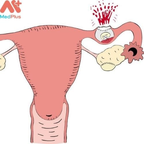 Thai ngoài tử cung có thể làm vỡ vòi dẫn trứng (Hình ảnh minh họa)