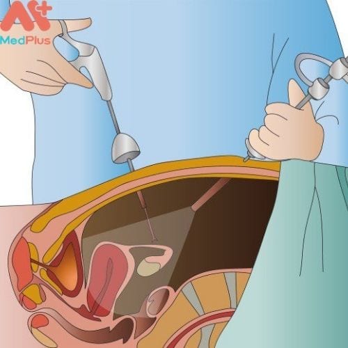 Thông qua nội soi ổ bụng, bác sĩ có thể tiến hành loại bỏ phôi thai nằm ngoài tử cung (Hình ảnh minh họa)