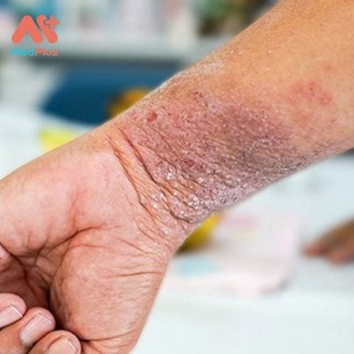 Bệnh chàm trên tay là một vấn đề rất phổ biến.