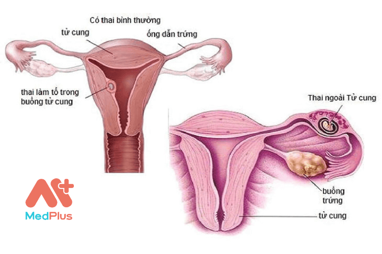 Bệnh phụ khoa tắt vòi trứng