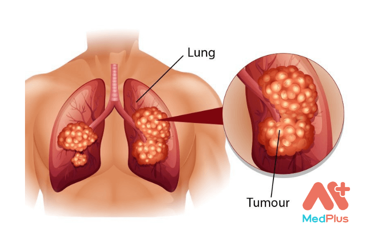 Dấu hiệu ung thư phổi thường gặp