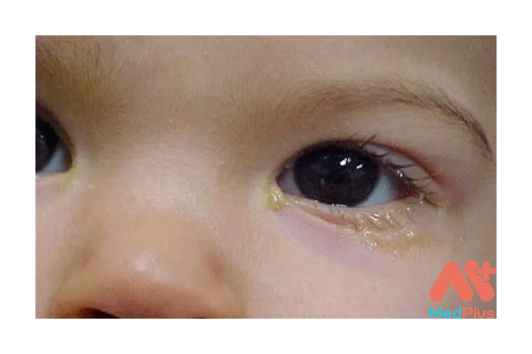 Đôi mắt của trẻ sơ sinh và việc tắt tuyến lệ