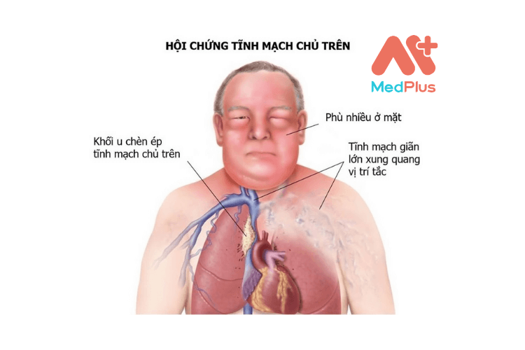 Hội chứng tĩnh mạch chủ trên có thể xảy ra khi các khối u trong phổi đè lên tĩnh mạch chủ trên