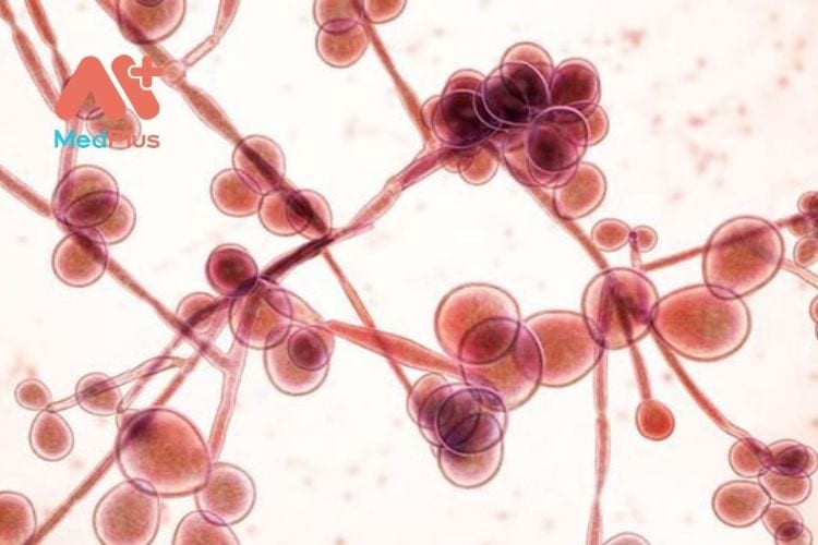 Cách chọn dung dịch vệ sinh cho người bị nấm Candida và TOP 6+ sản phẩm 129 Nguyên nhân và dấu hiệu bệnh lý viêm âm đạo do nấm Candida