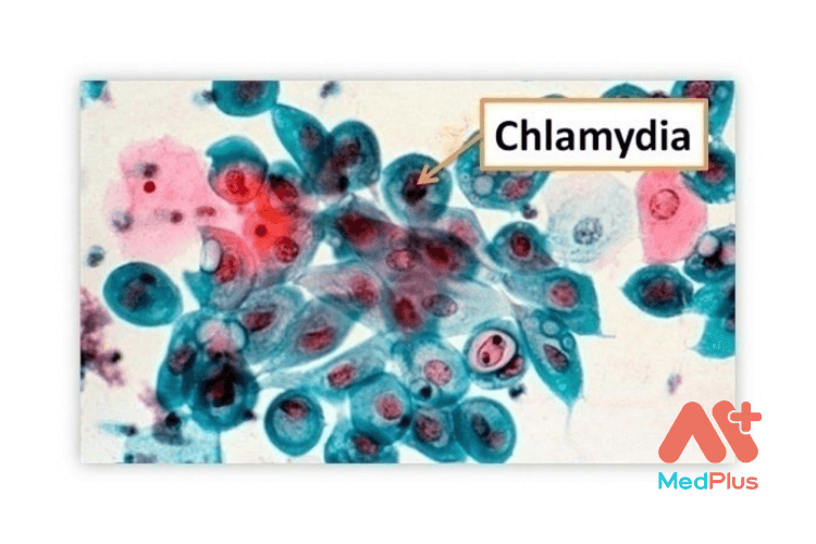 Nhiem chlamydia - Medplus