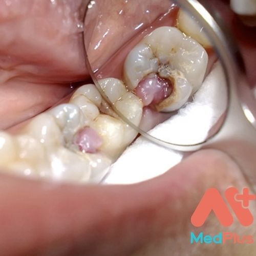 Triệu chứng viêm tủy răng là gì?