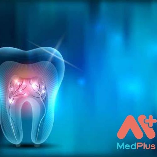 Viêm tủy răng là gì