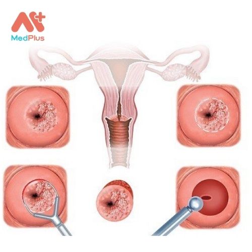 Viêm cổ tử cung là tình trạng viêm nhiễm xảy ra ở cổ tử cung, phần dưới của tử cung hẹp và kết thúc với âm đạo.