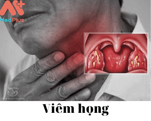 Viêm họng