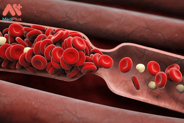 Xarelto 20mg ngăn ngừa cục máu đông