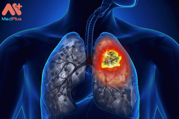 Zykadia 150mg trị ung thư phổi không tế bào nhỏ