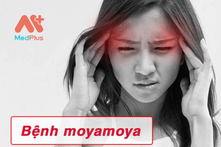 Bệnh moyamoya: Triệu chứng, chẩn đoán và điều trị bệnh
