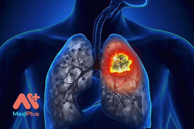 ngăn ngừa ung thư phổi