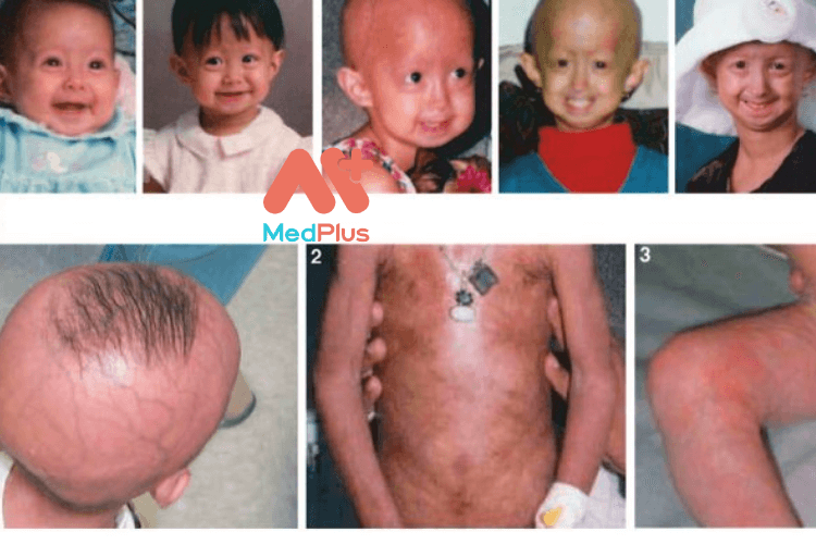 progeria 1 2 - Medplus