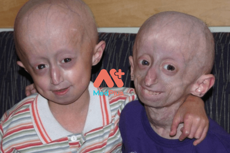 progeria 1 - Medplus
