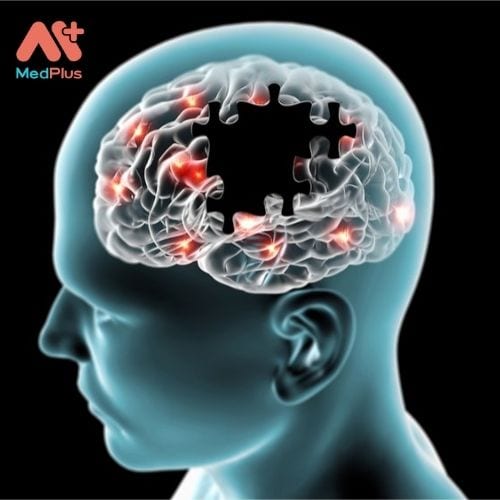 Bệnh Alzheimer là một trong những căn bệnh về não