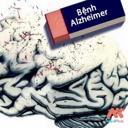 Benh Alzheimer - Medplus