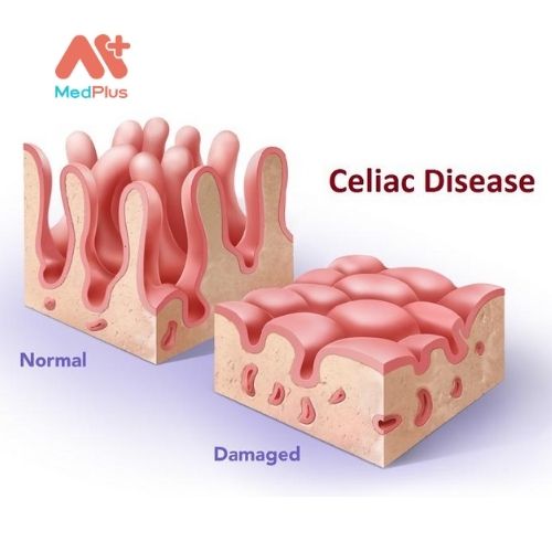 Bệnh Celiac là một chứng rối loạn tự miễn dịch được kích hoạt khi bạn ăn gluten 
