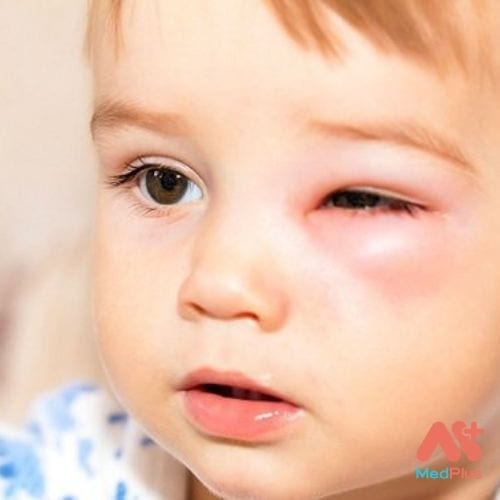 Bệnh Chagas: Những lưu ý về căn bệnh truyền nhiễm này 129 Bệnh Chagas là bệnh do nhiễm ký sinh trùng Trypanosoma cruzi