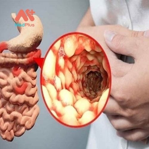 Bệnh Crohn là một bệnh viêm mãn tính của đường tiêu hóa.