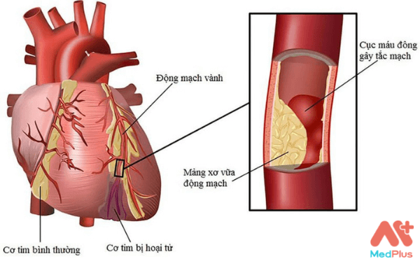 Bệnh động mạch vành (bệnh mạch vành)