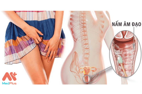 Polisnale điều trị nấm âm đạo