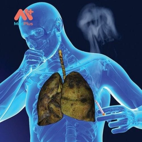 Ung thư phổi xảy ra khi các tế bào phân chia trong phổi không kiểm soát được.