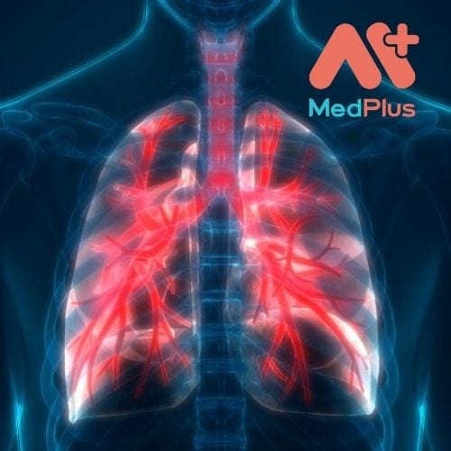 BỆNH PHỔI TẮC NGHẼN MÃN TÍNH LÀ GÌ? 130 Bệnh phổi tắc nghẽn mãn tính
