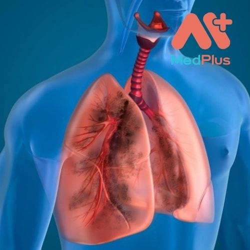 BỆNH PHỔI TẮC NGHẼN MÃN TÍNH LÀ GÌ? 129 Bệnh phổi tắc nghẽn mãn tính