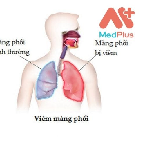 Bệnh Viêm màng phổi