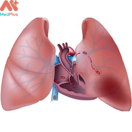 Máu đông không được điều trị có thể gây thuyên tắc phổi