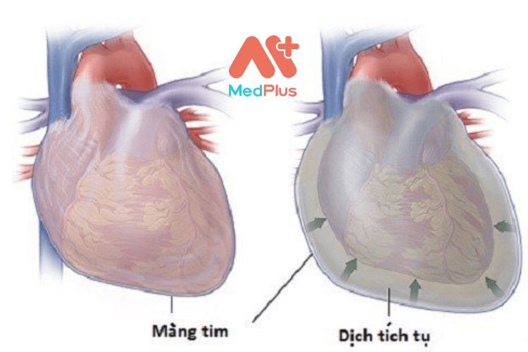 tràn dịch ngoài màng tim