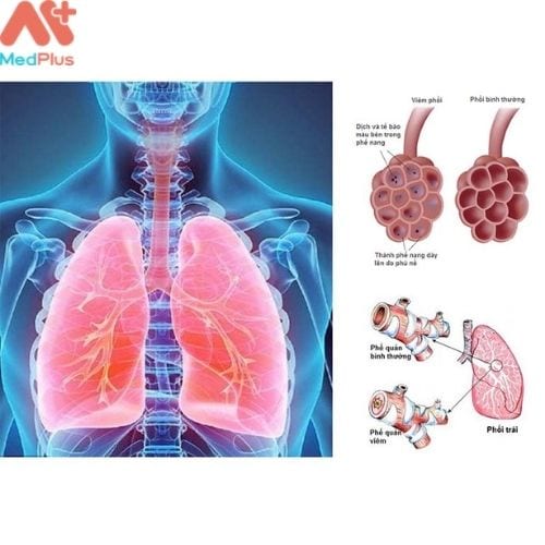 Viêm phế quản có thể dẫn tới viêm phổi