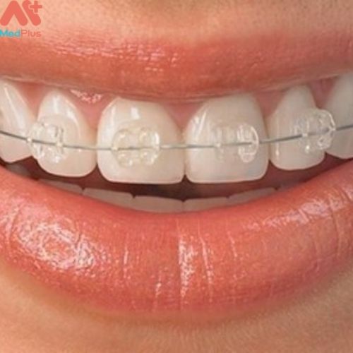 Dịch vụ niềng răng tại Nha khoa Dr Dương đem đến hàm cho khách hàng hàm răng đều, cân đối