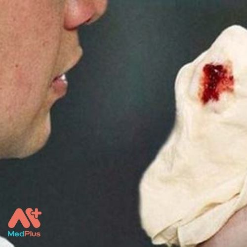 Ho ra máu là máu từ đường hô hấp dưới được ho, khạc, trào, ộc ra ngoài theo đường miệng, mũi.