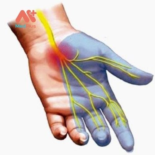 Hội chứng ống cổ tay là tình trạng phổ biến trong cộng đồng gây đau, tê