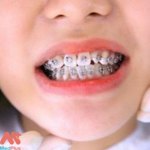 Nha khoa Tâm Thế Đà Lạt cung cấp dịch vụ niềng răng chuyên sâu