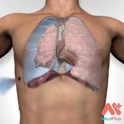 Bệnh tràn dịch màng phổi