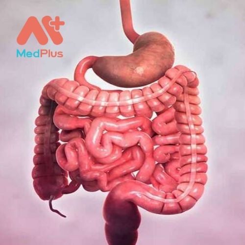 Bệnh Crohn còn được gọi là bệnh viêm ruột mạn tính từng vùng.