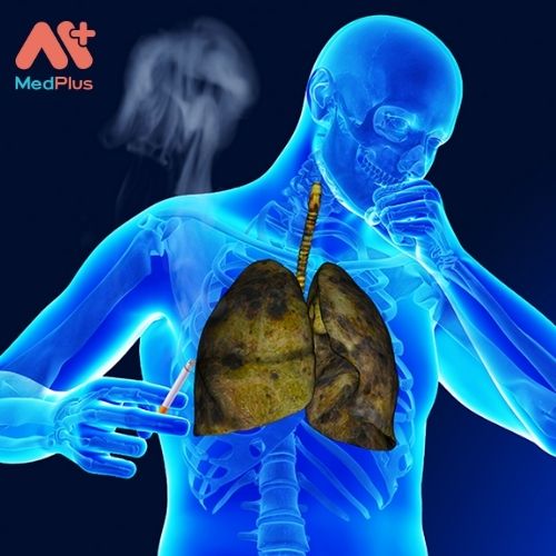Bệnh lao phổi (TB) là một bệnh nhiễm khuẩn truyền nhiễm thường tấn công phổi.