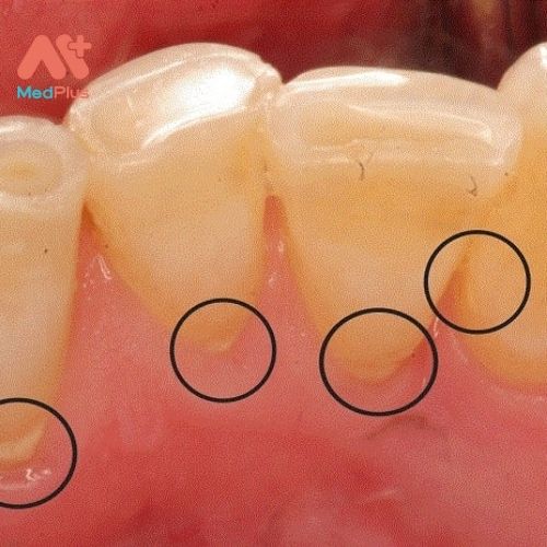 Cao răng hay các mảng bám cứng đầu tại chân răng không được loại bỏ cũng khiến bạn gặp vấn đề chảy máu chân răng