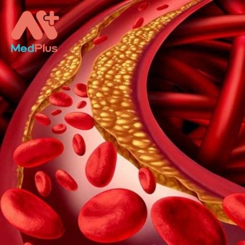 Cholesterol trong máu cao gây bệnh